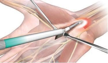 Could Palm Surgery Change Your Future?