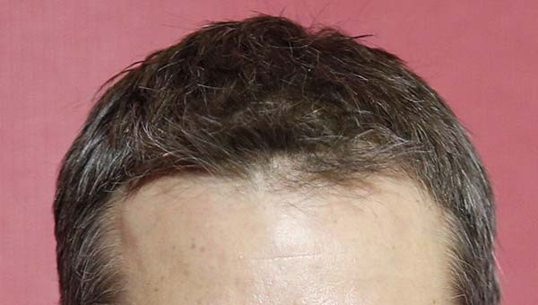 Types of Forehead Hairlines, Hairline Shapes and Meanings