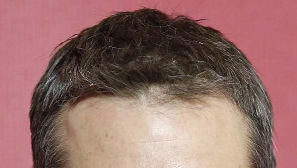 Types of Forehead Hairlines, Hairline Shapes and Meanings Types of Forehead Hairlines, Hairline Shapes and Meanings