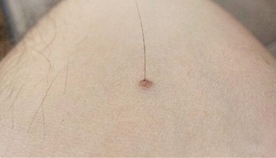 Hair on Mole Good or Bad? Hairy Moles in Chinese Face Reading