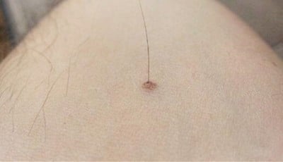 Hair on Mole Good or Bad? Hairy Moles in Chinese Face Reading Hair on Mole Good or Bad? Hairy Moles in Chinese Face Reading