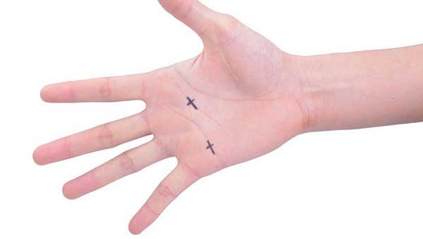 Do Scars on Palm Change a Person's Fate or Personality?